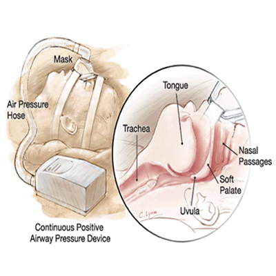  Restless Leg Syndrome